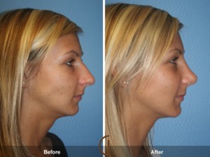 Facts About Rhinoplasty and its Cost