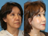 How Long Does Cosmetic Surgery Last