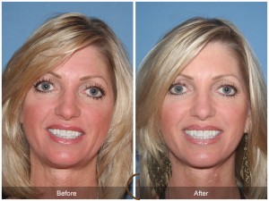 Irvine Traditional Facelift