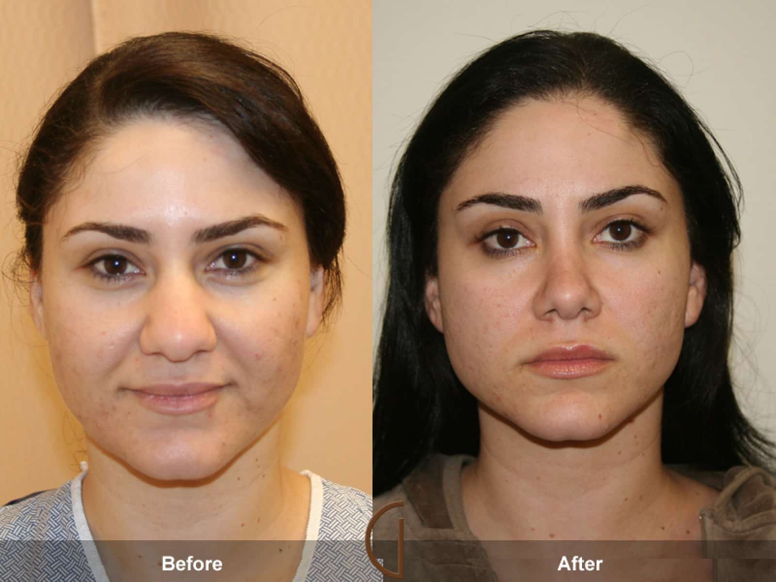 Rhinoplasty Nose Surgery Rolling Hills Estates CA Before After Photo 3