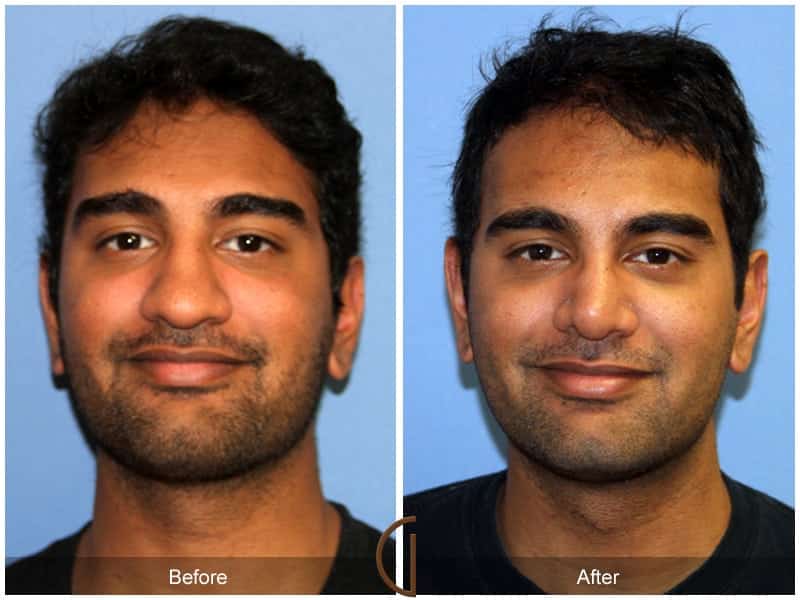 Pin on Ethnic Rhinoplasty (Nose Job)