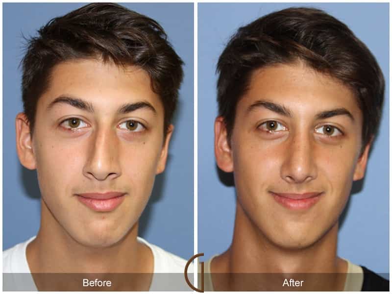 Male Rhinoplasty Corona Del Mar CA 102 Before and After Photos
