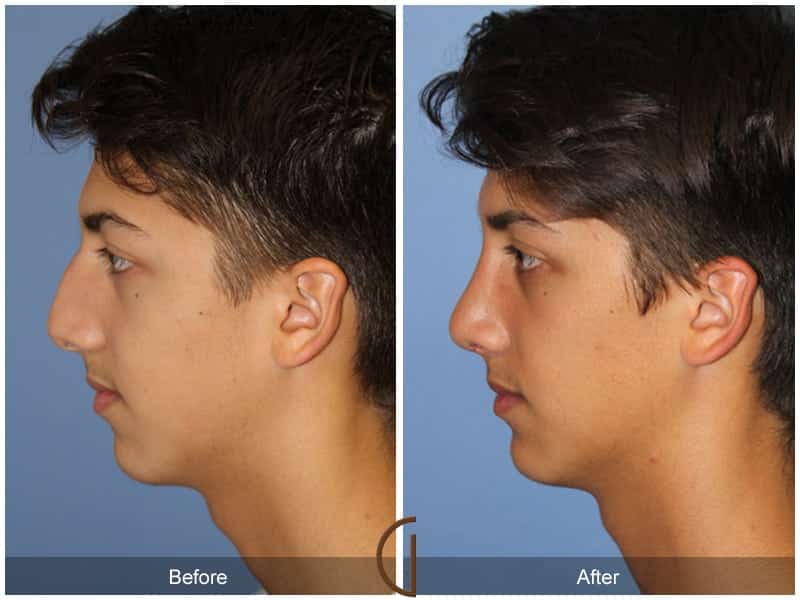 Revision Rhinoplasty in Los Angeles - Sedgh Plastic Surgery