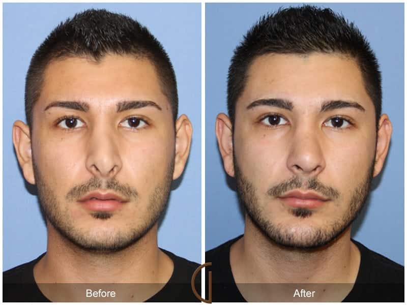 Before and after rhinoplasty, nose job, nose surgery. 