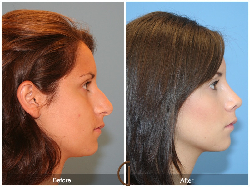 Rhinoplasty Nose Surgery Orange County CA Before After