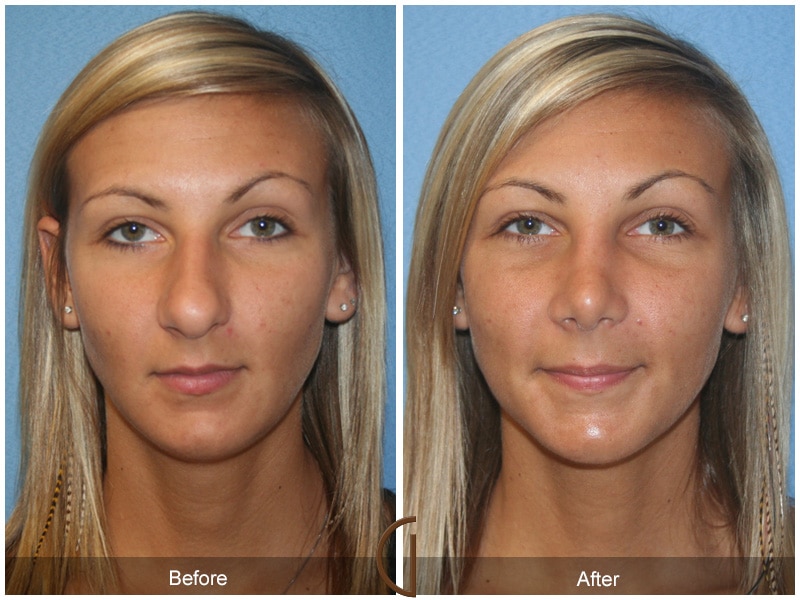 Rhinoplasty Nose Surgery Orange County Ca Before After Photo 35