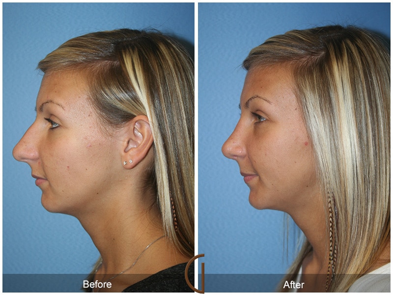 Rhinoplasty Nose Surgery Orange County Ca Before After Photo 35