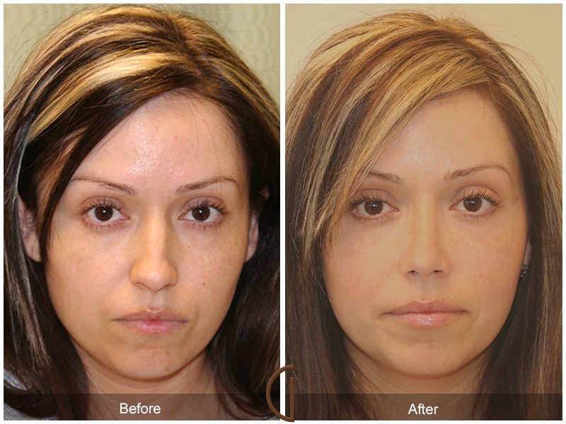 Rhinoplasty Nose Surgery Encinitas CA Before After Photo 7