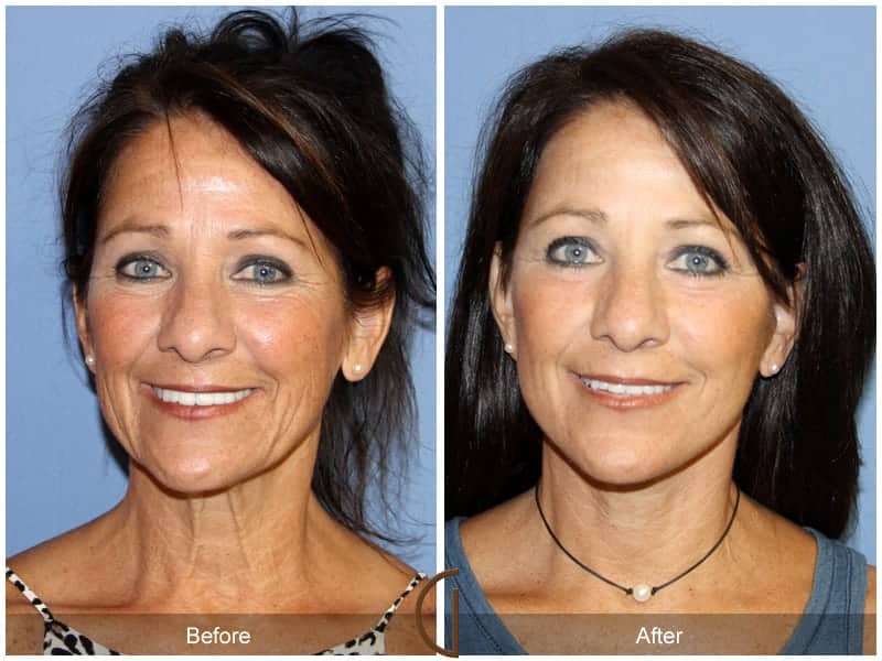 Lower Facelift And Neck Lift Newport Beach Dr Kevin Sadati