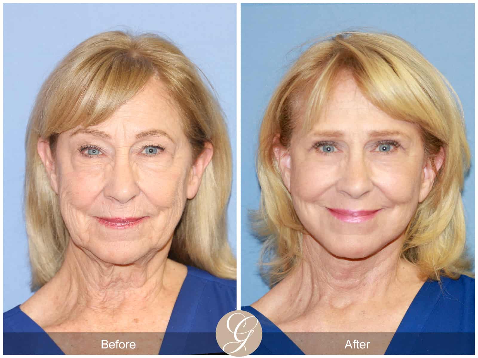 Neck Lift 413 Before After Photos Orange County