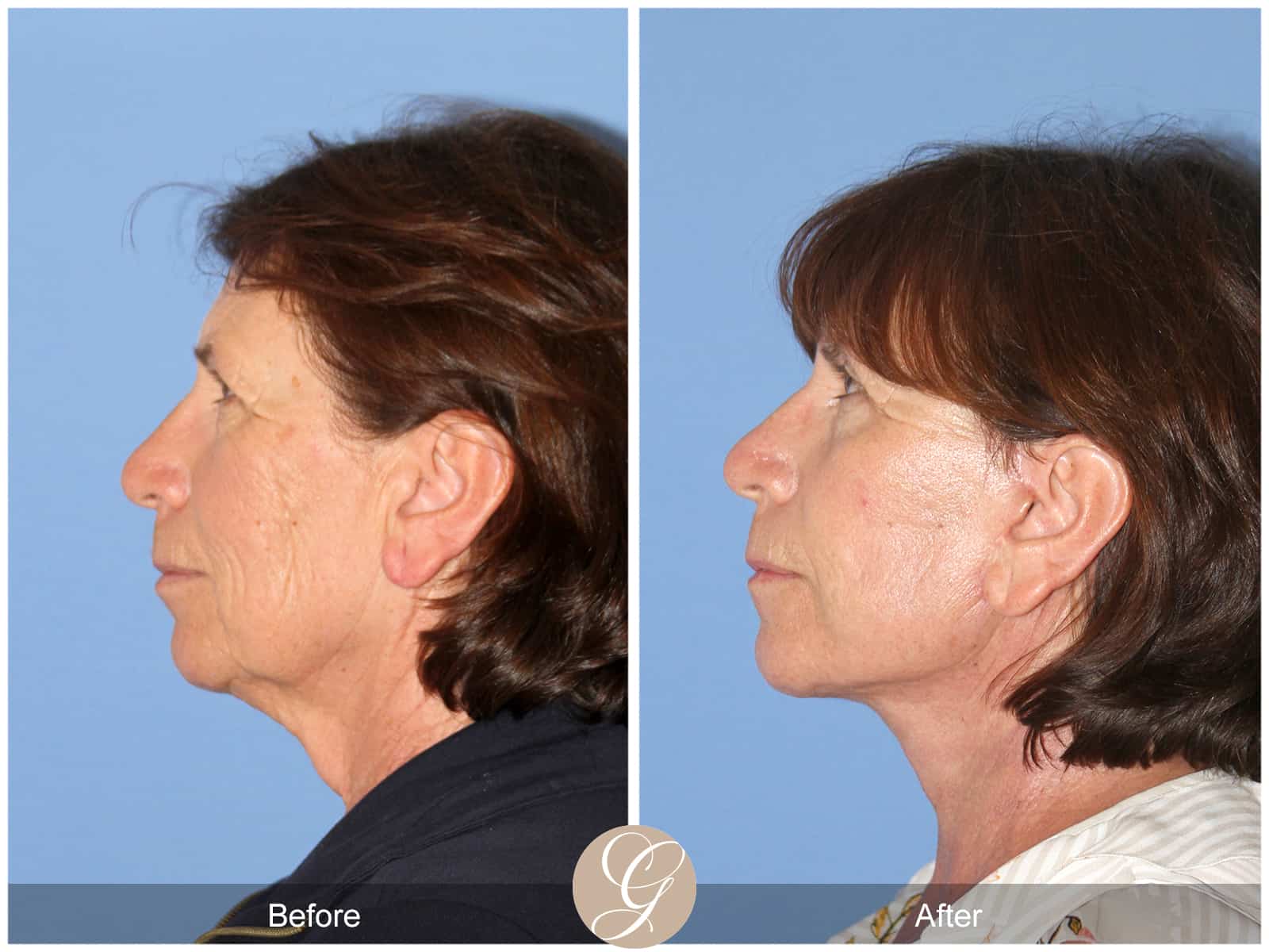 Neck Lift Newport Beach CA Best Lower Facelift Surgeon Near Me Orange