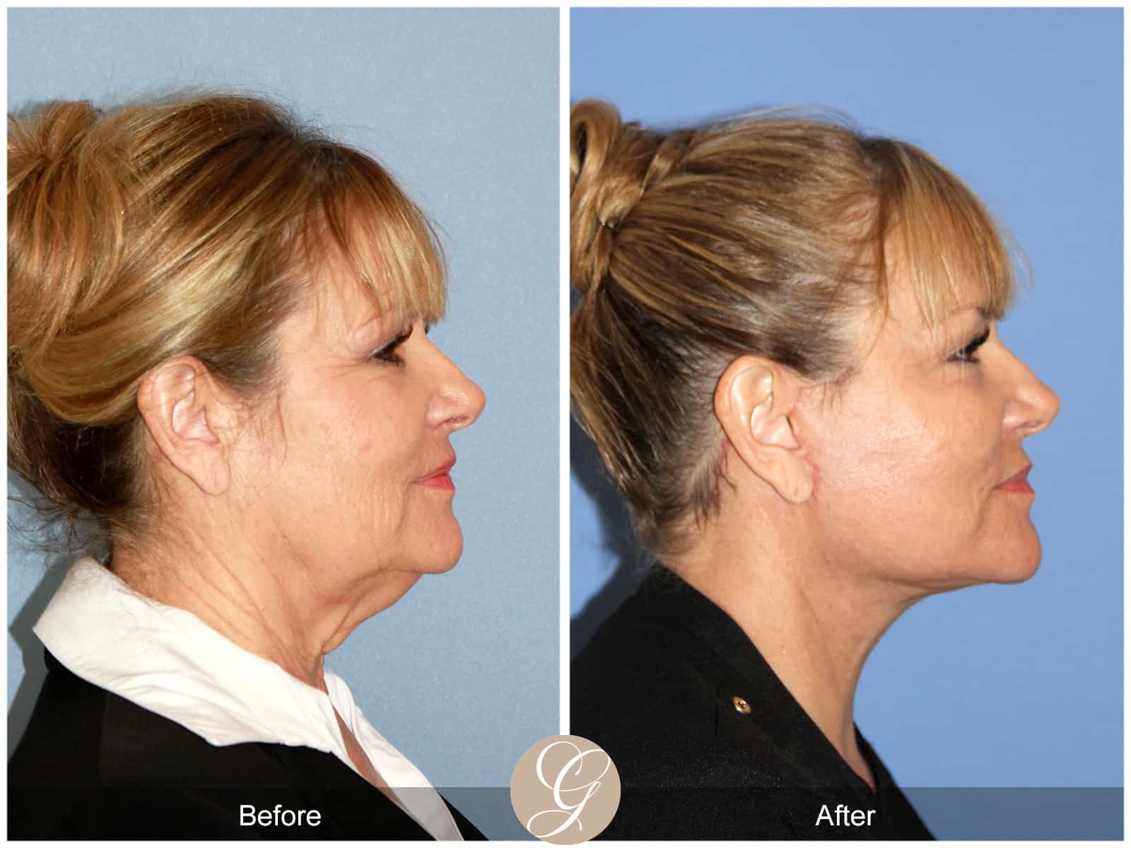 Face And Neck Lift 404 Before After Photos Orange County