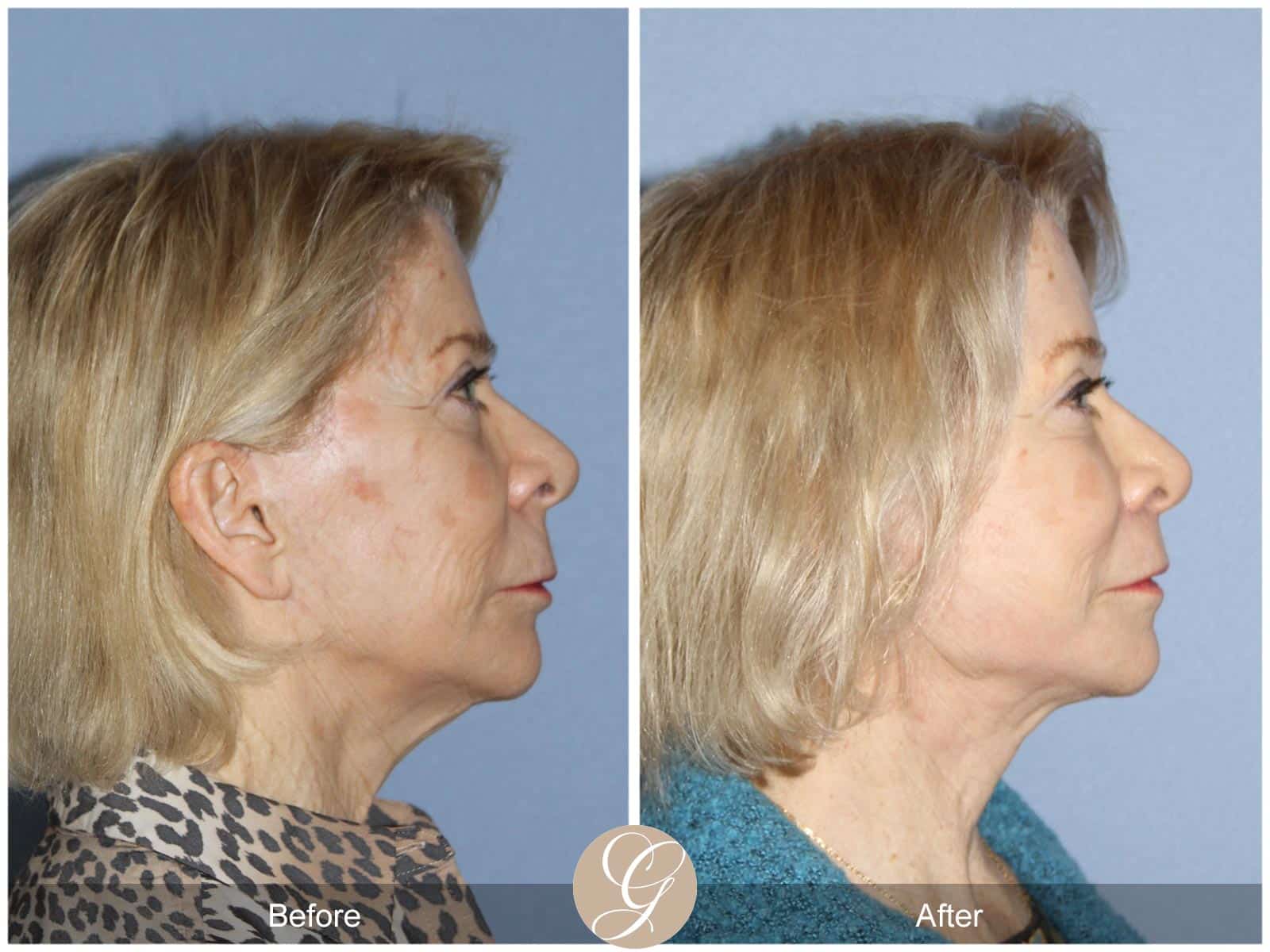 Natural Lift, Lip Lift, CO2 Laser 427 Before After Photos Orange County