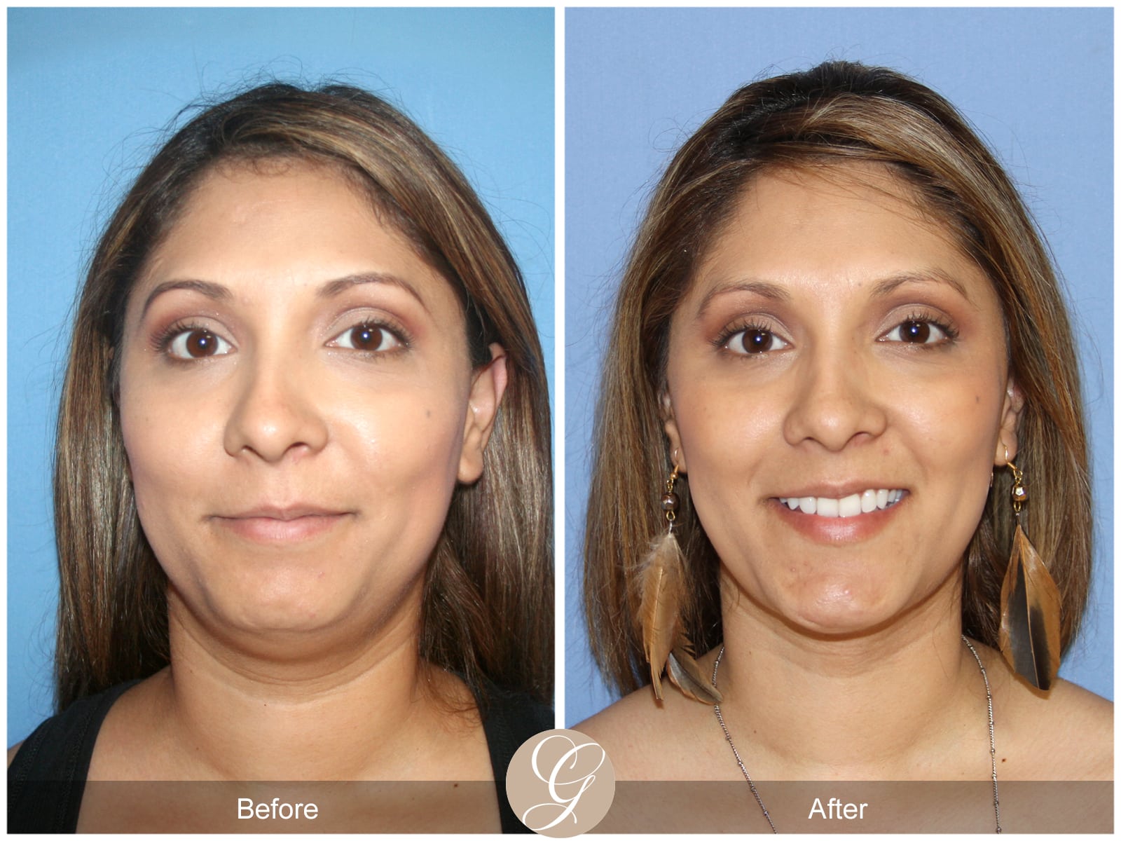Neck Liposuction Chin Augmentation 27 Before After Photos
