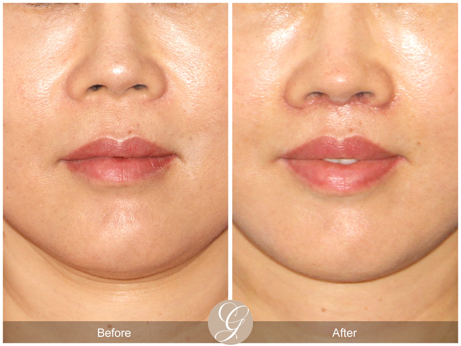 Lip Lift Orange County Ca Sadati Md