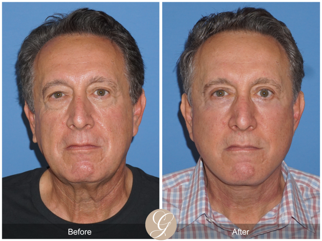 Lower Face and Neck Lift