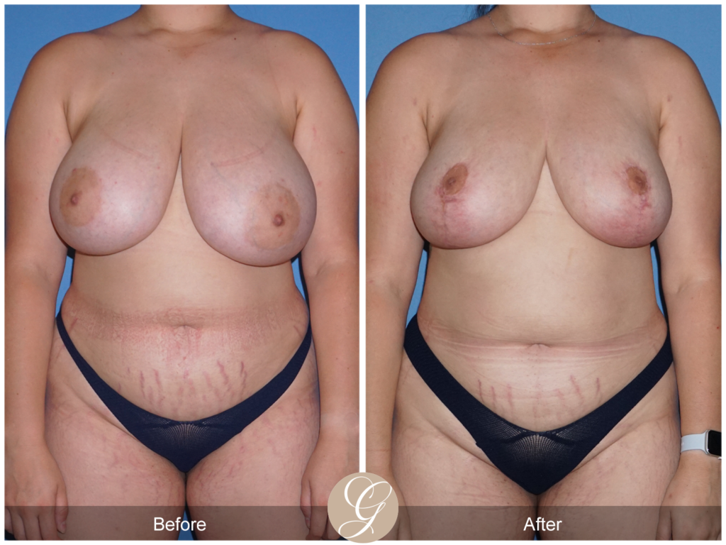 Breast reduction, breast lift, plastic surgery, Dr. Florin