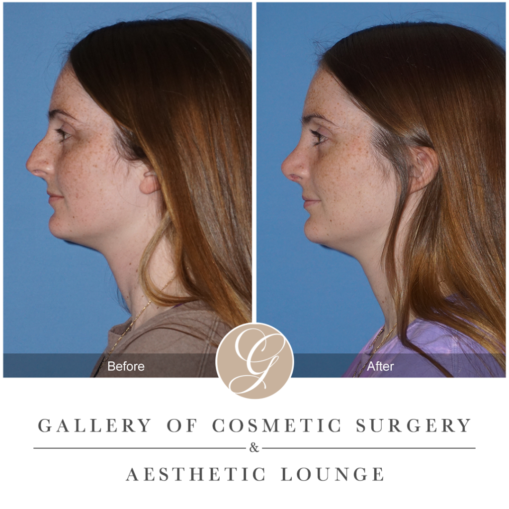 What is the Best Age for Teenage Rhinoplasty?
