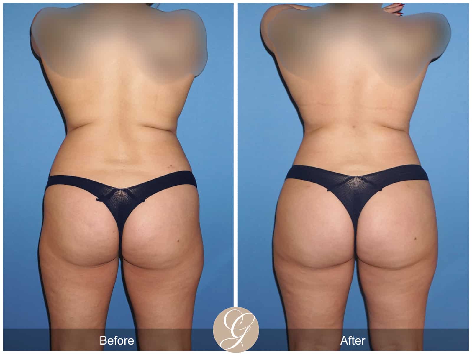 Brazilian Butt Lift Before and After Photo Gallery