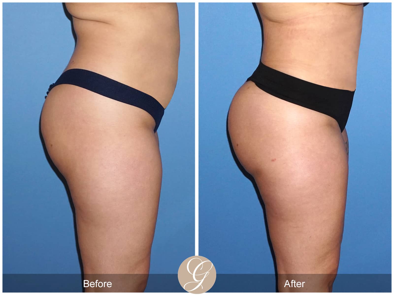 Buttock Augmentation/Brazilian Butt Lift Before and After Pictures