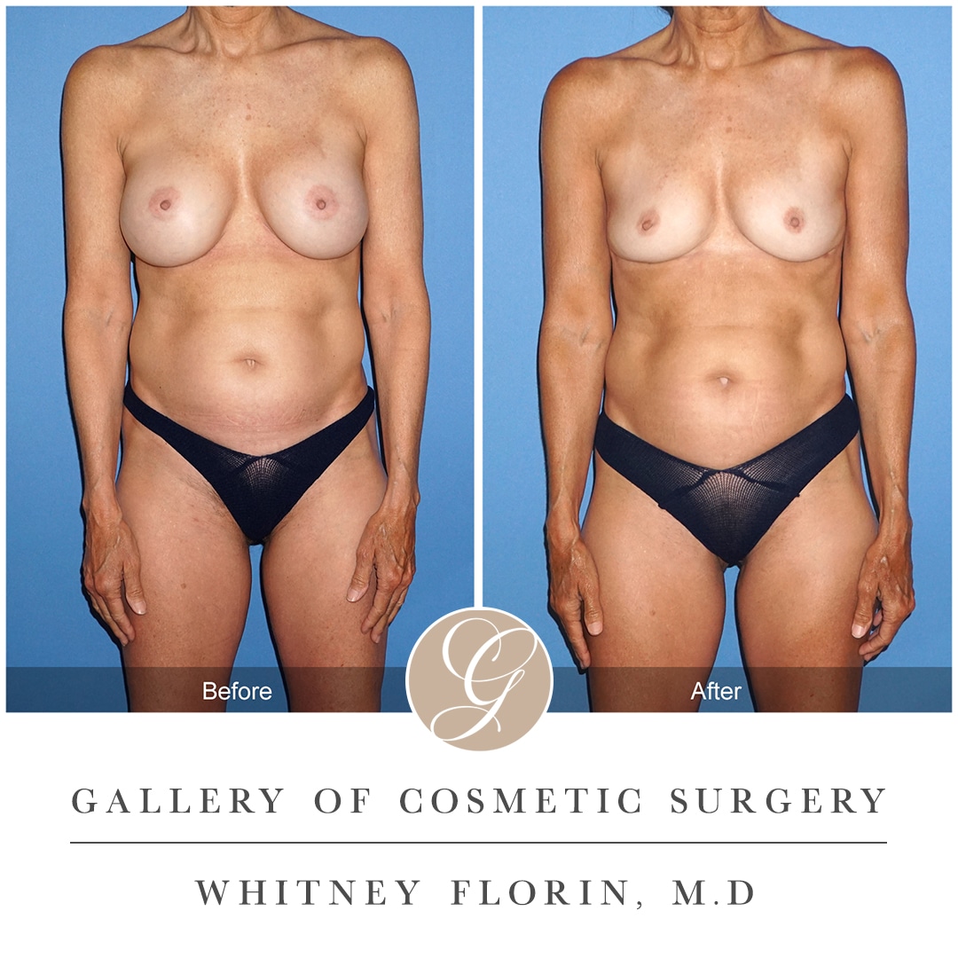 Breast implant removal (explant) Case 1 Before After Photos Orange County