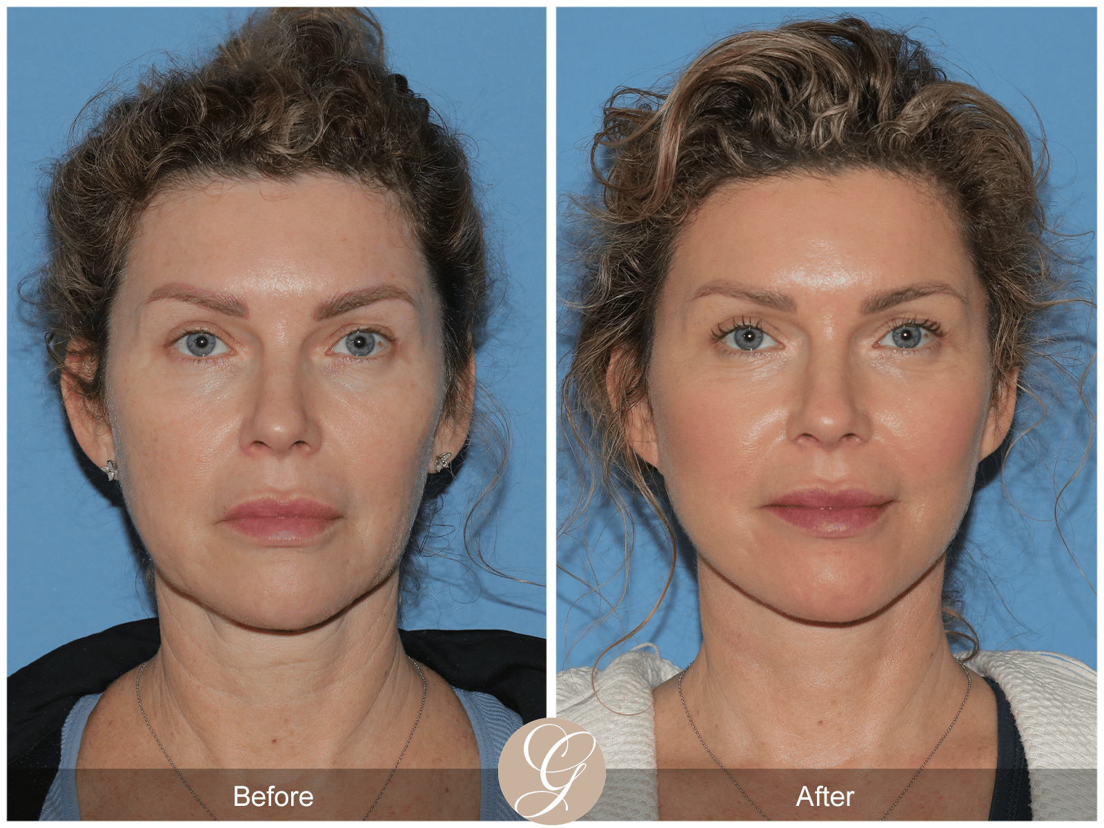 FACELIFT Before After Photos Dr. Sadati - FACE - FACELIFT Orange