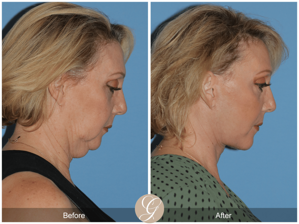 How Long Does Recovery Take for a Deep Plane Facelift?