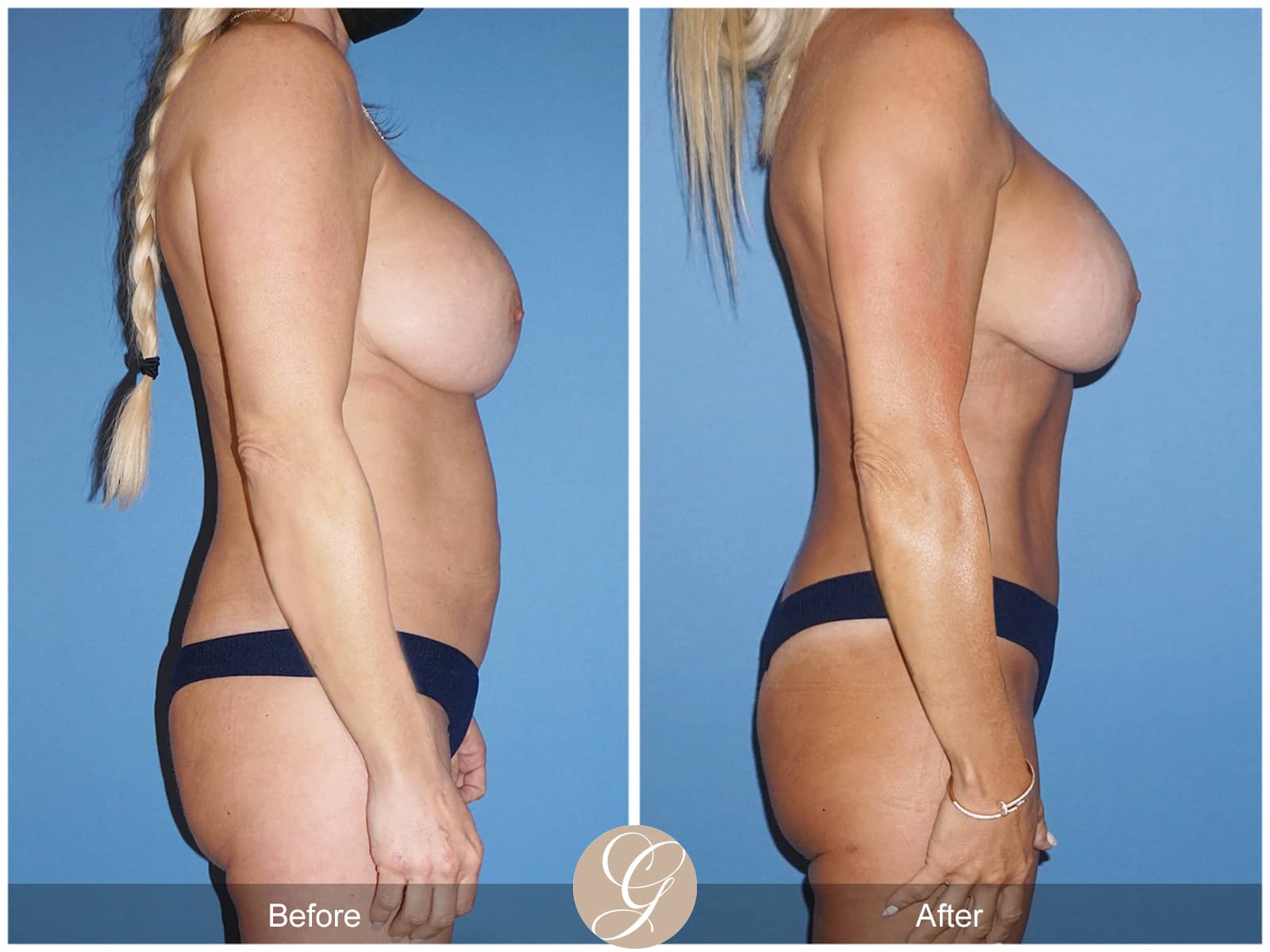 Breast revision (internal bra) Gallery Case 2 Before After Photos Orange  County