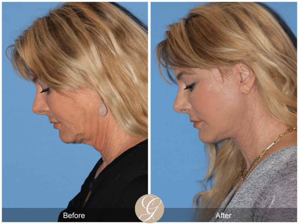 What is the Difference between SMAS vs. Deep Plane Facelift