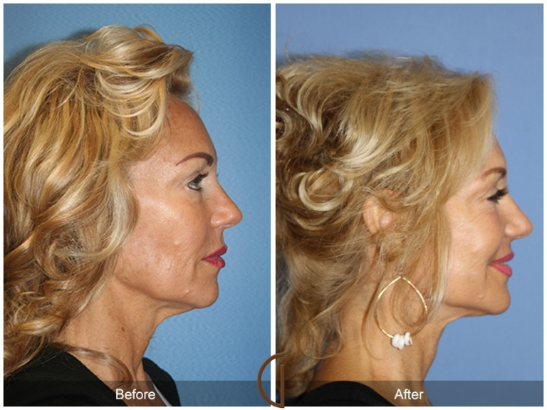 What is the Difference between SMAS vs. Deep Plane Facelift | Sadati, MD