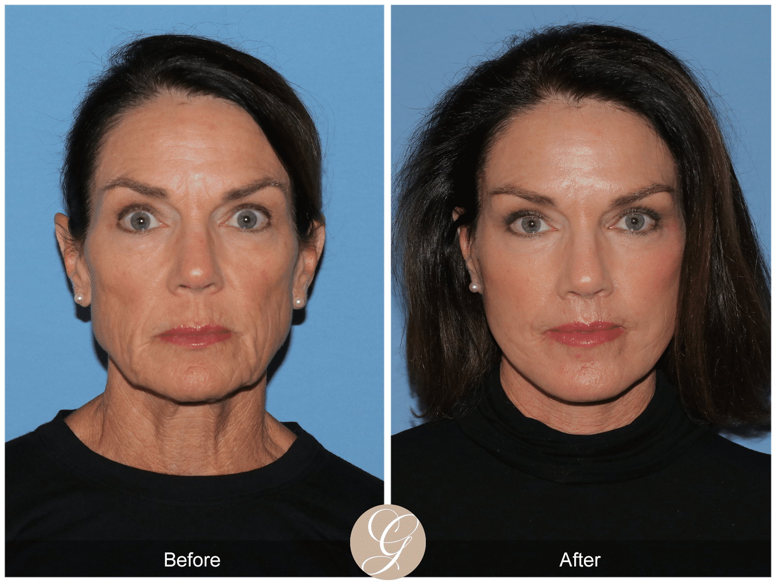 What is the importance of compression after facelift surgery?