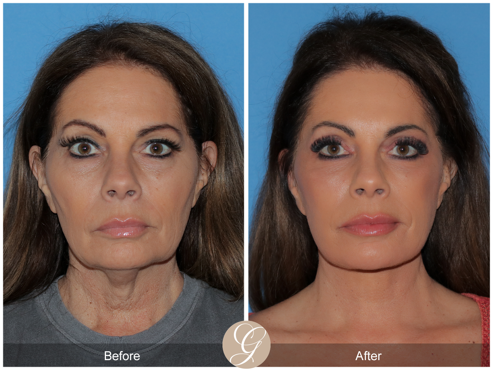 What is The Natural Facelift?, Blog