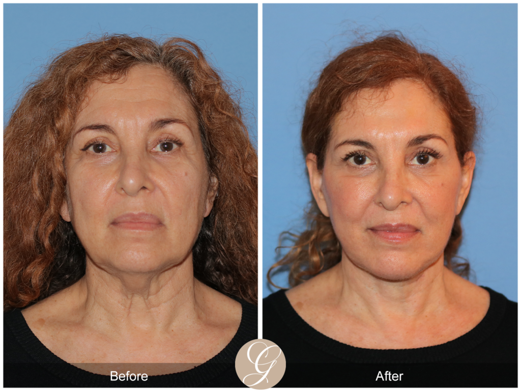 Preservation Facelift Case 5