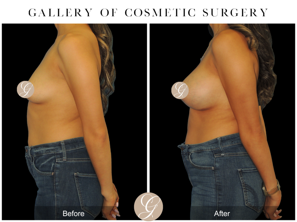 Breast Augmentation PT13