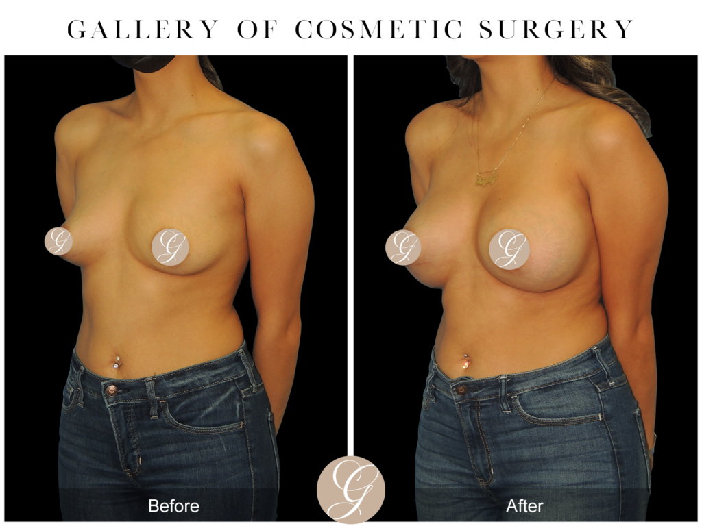 Breast Augmentation PT13