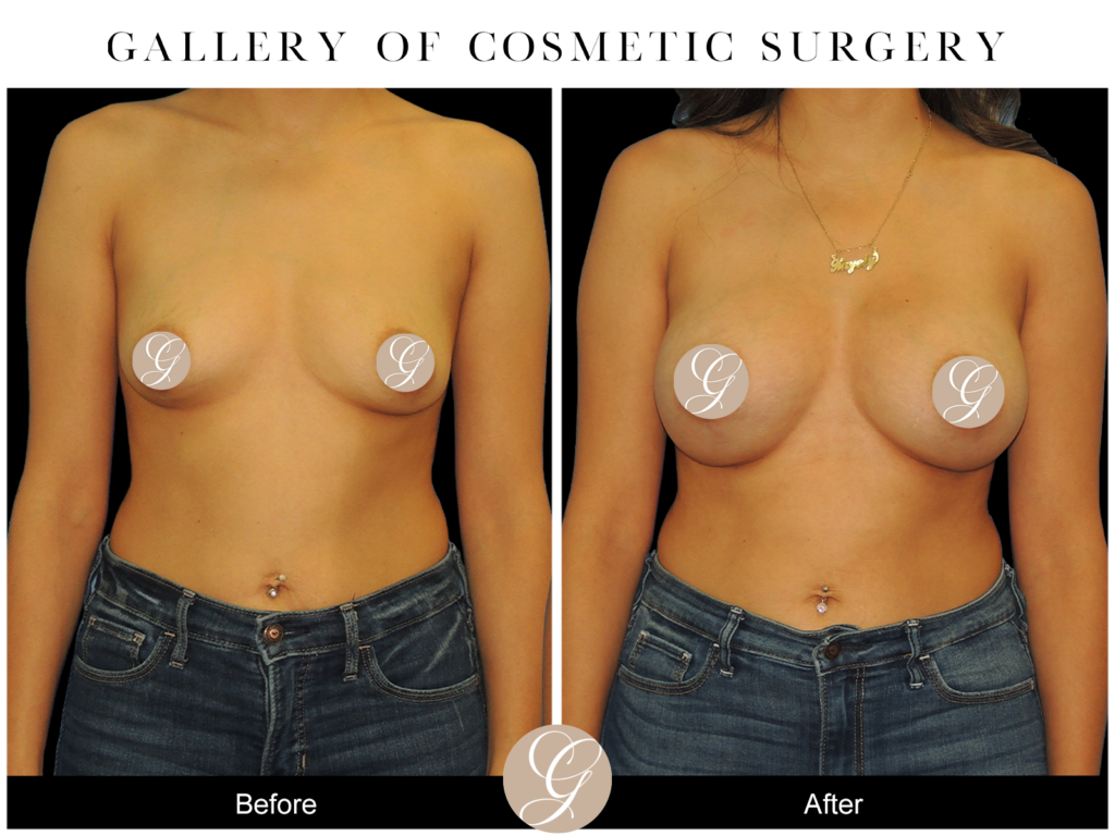 Breast Augmentation PT13