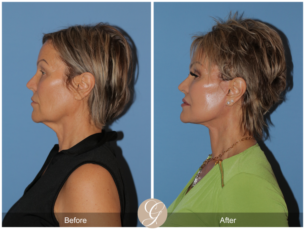 Preservation Facelift Case 20