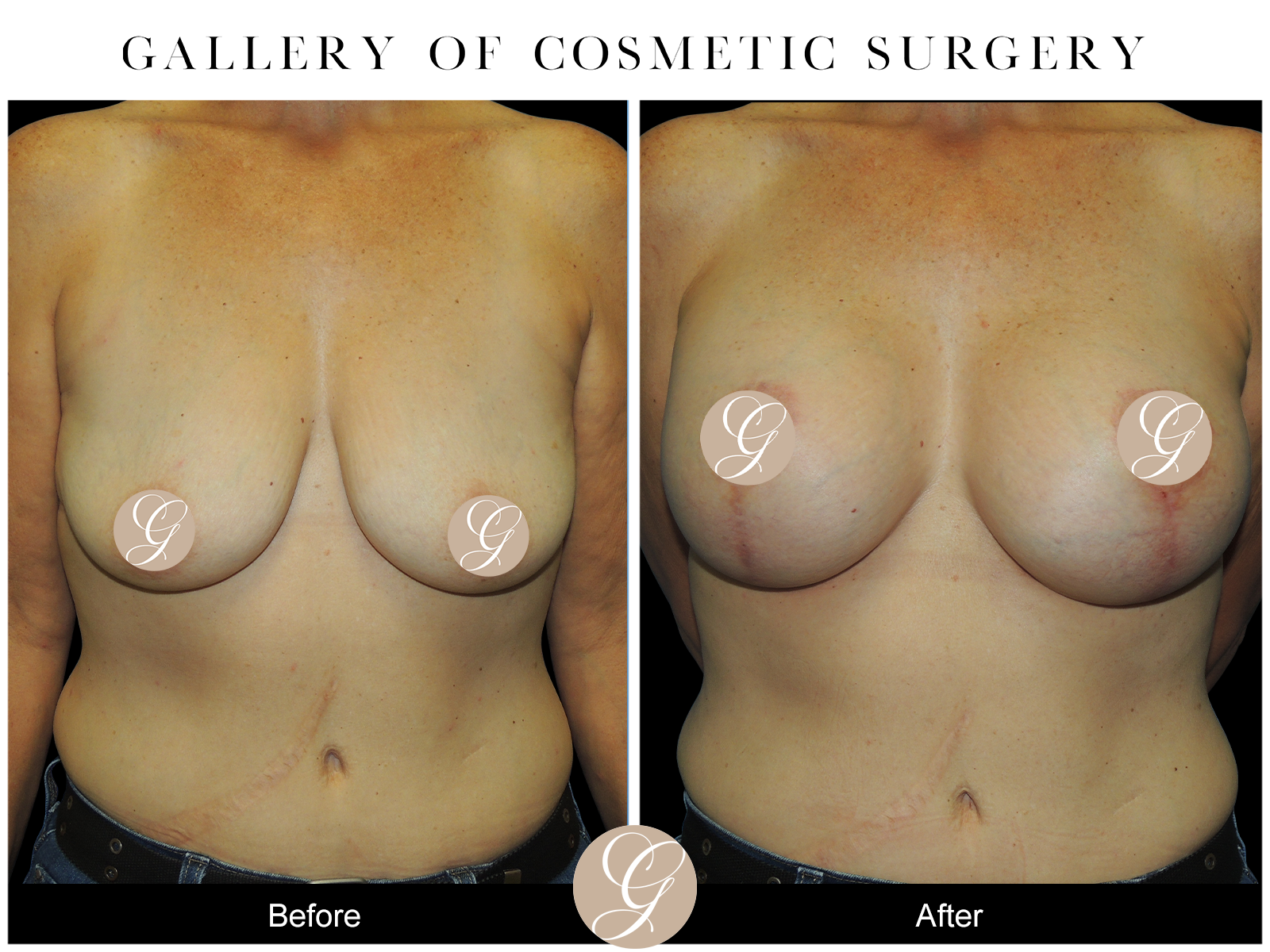 Breast Augmentation with Breast Lift