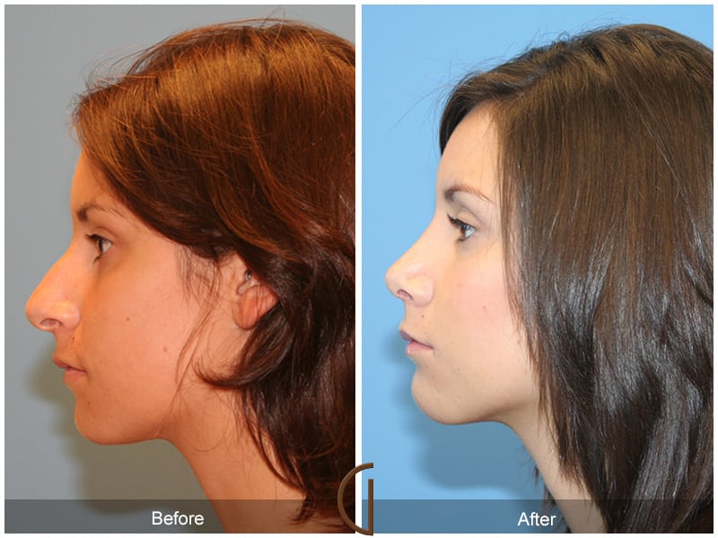 Before After Rhinoplasty 25 Image