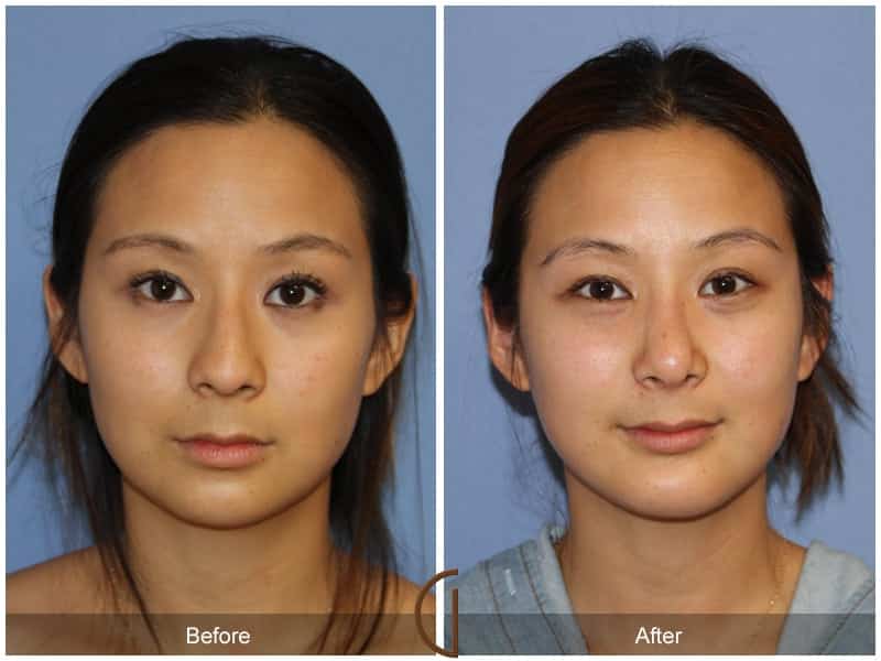 Rhinoplasty & Chin Villa Park CA 4 Image