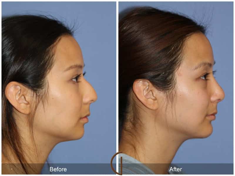 Rhinoplasty & Chin Villa Park CA 4 Image