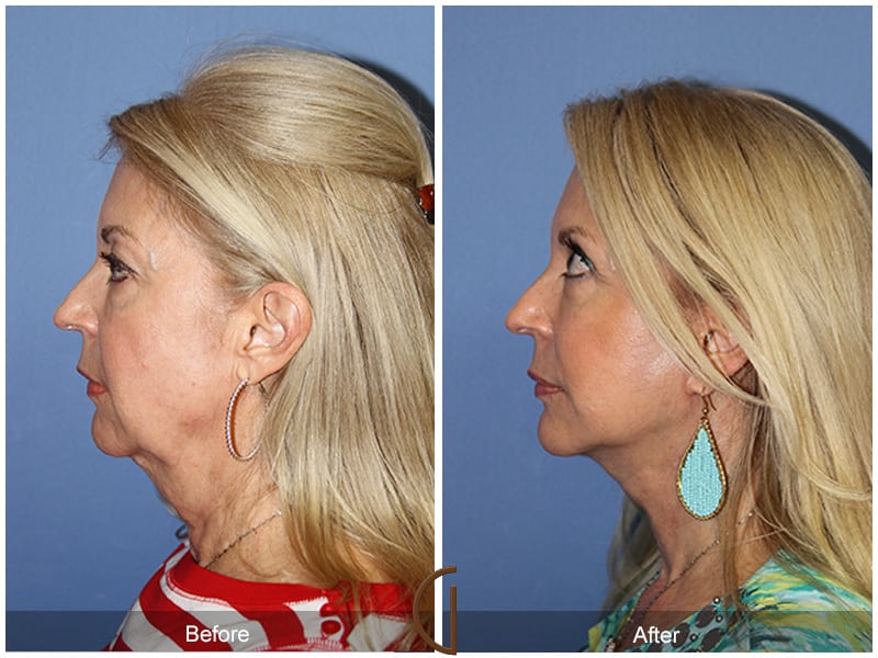 Facelift Newport Beach 181 Image