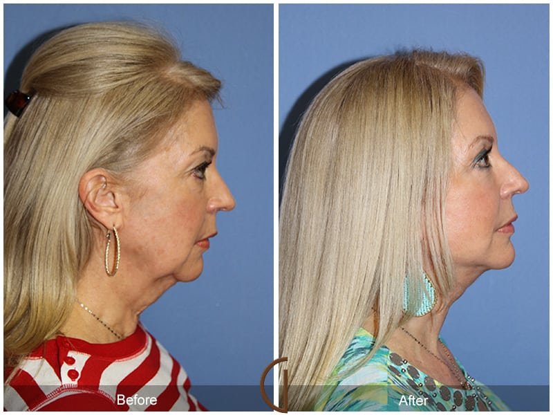 Facelift Newport Beach 181 Image