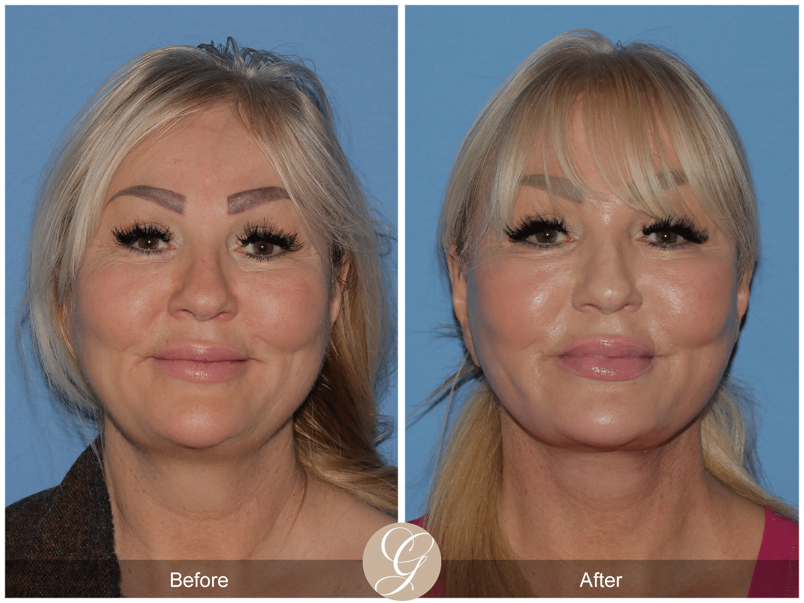 Deep Plane Facelift Case 10 Image