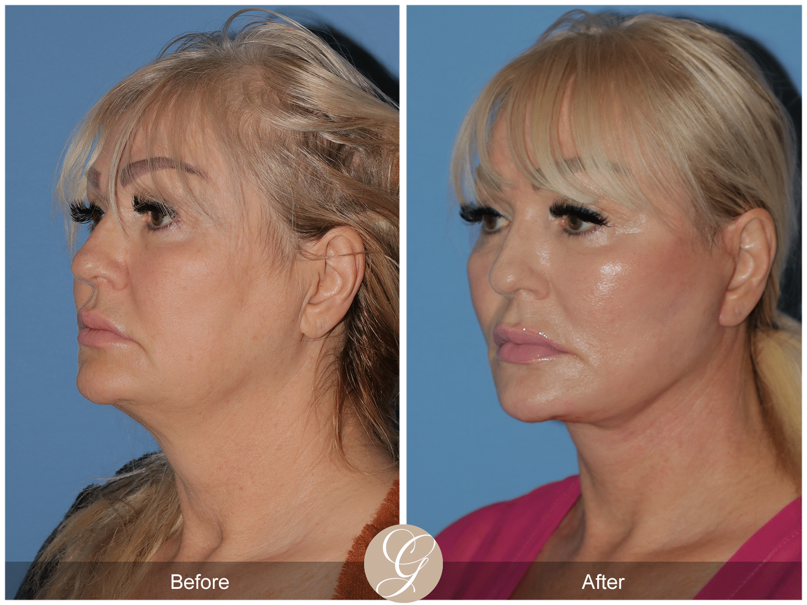 Deep Plane Facelift Case 10 Image