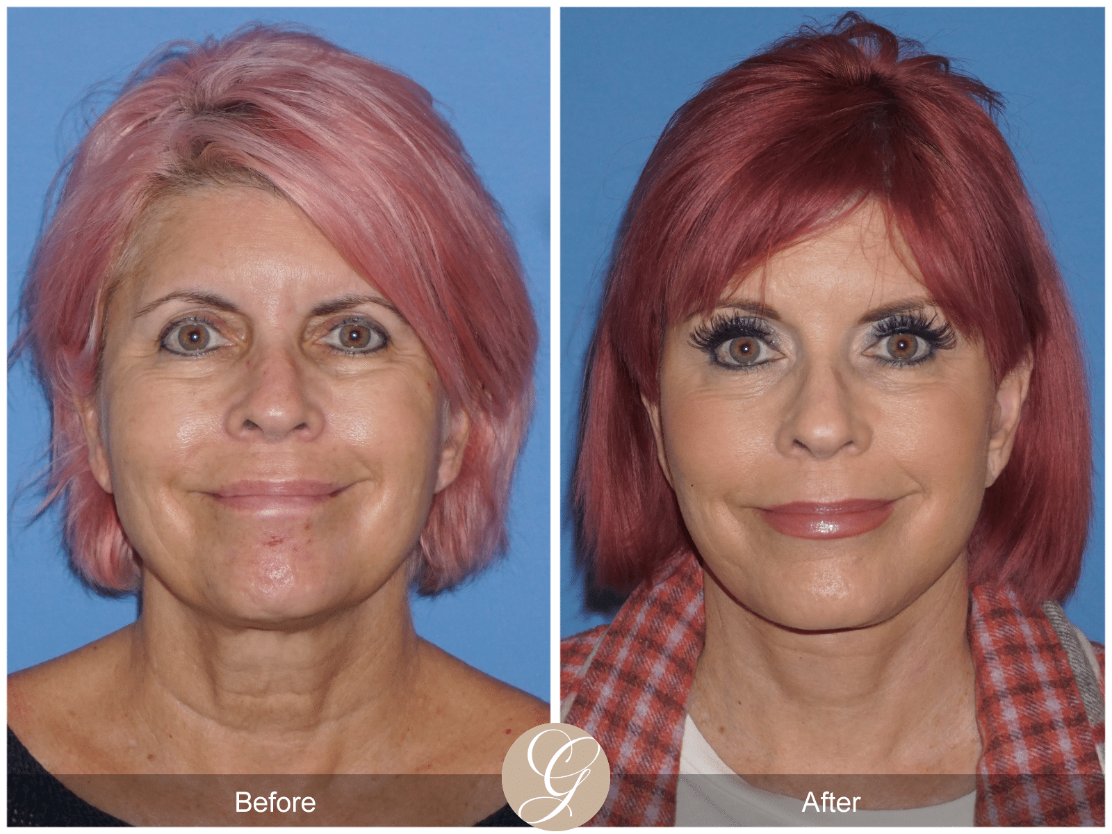 Vertical Facelift Case 4 Image