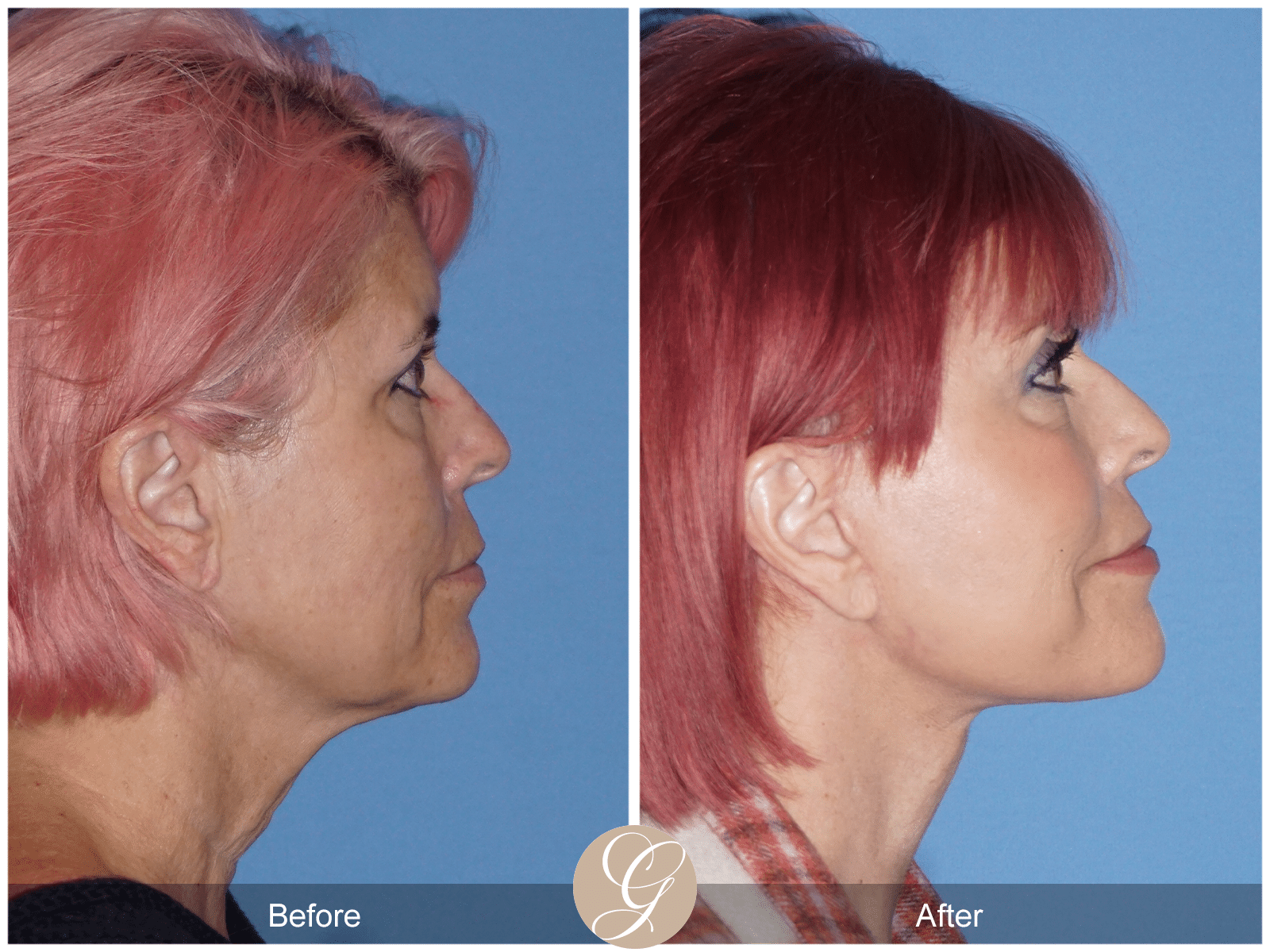 Vertical Facelift Case 4 Image