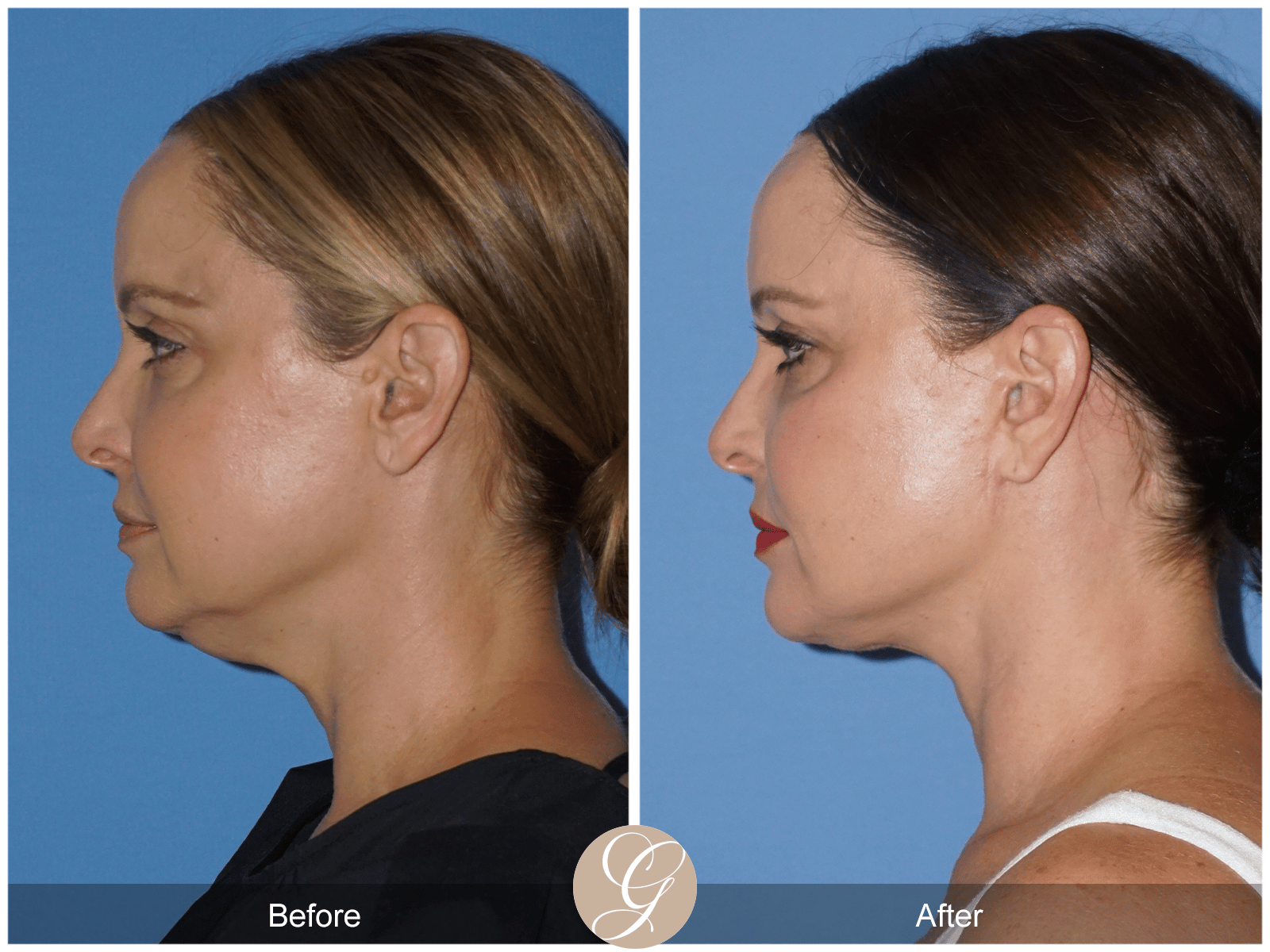 Lower Face and Neck Lift