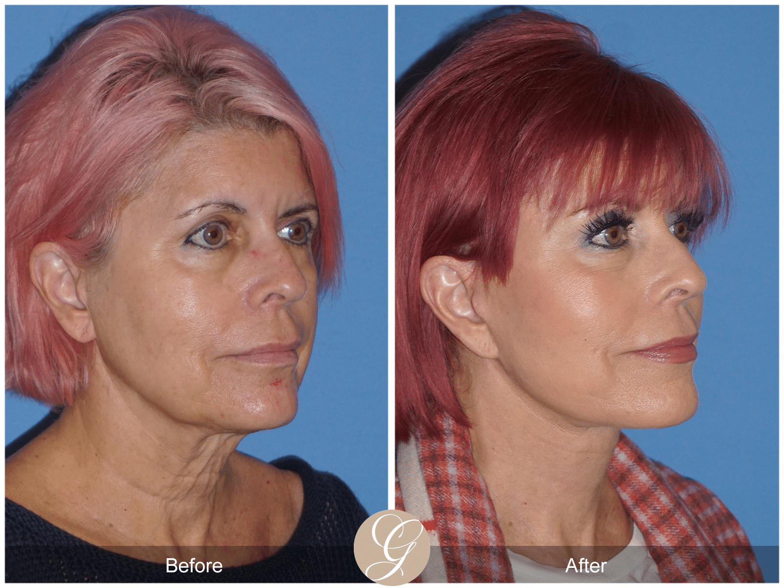 Vertical Facelift Case 4 Image