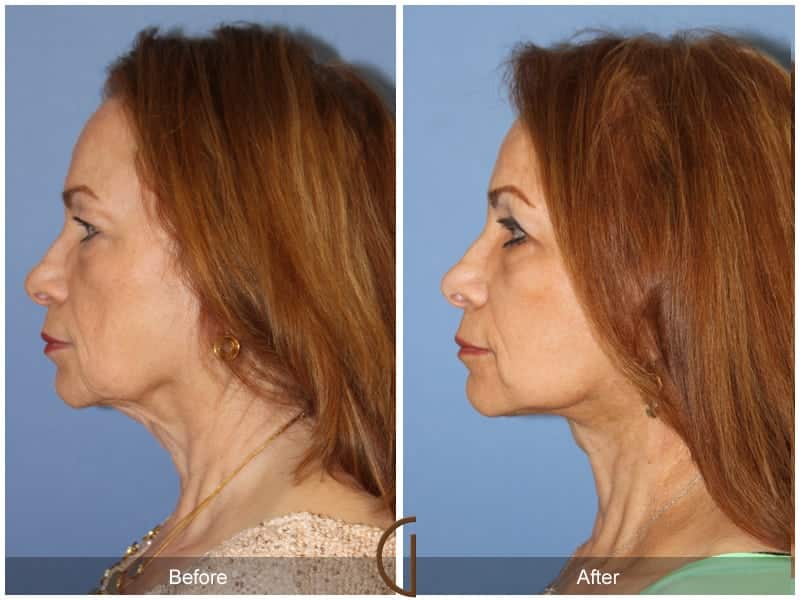 Facelift Newport Beach 182 Image